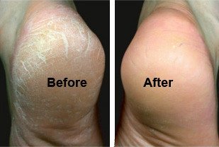 100% Herbal Care Foot Cracked Healing Krack Cream Crack Foot Heel 25g X 2 = 50g